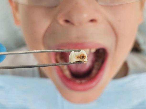 Best Dentist for Tooth Abscess  in Barnesville, GA